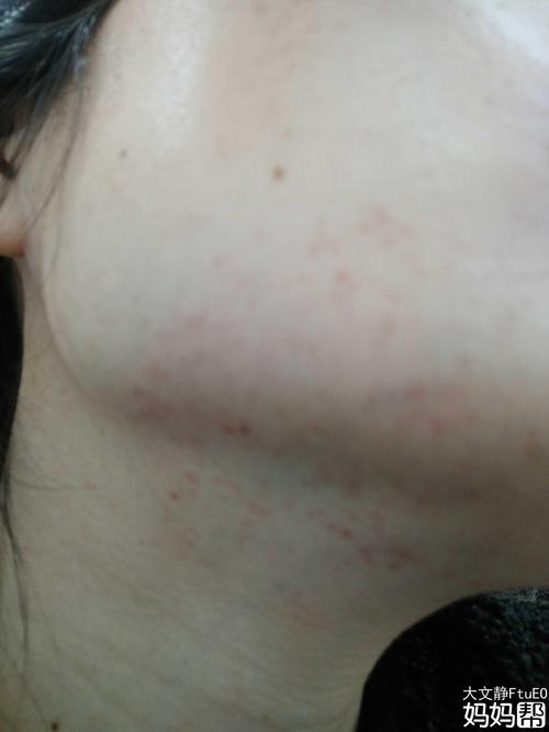 请问怀孕十八周脸上长红点,也不