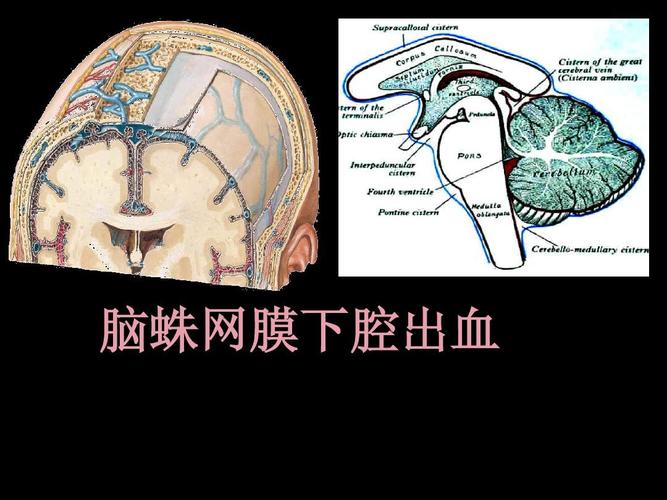 脑蛛网膜下腔出血ppt