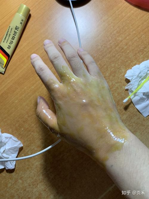 手被开水烫伤恢复记录多图慎入
