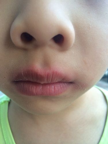 问:小孩嘴唇有一圈乌红色的的印迹,有时有有时无,请问是什么病吗?