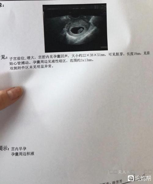 怀孕8周孕囊周边有积液,会不会影响胎儿健