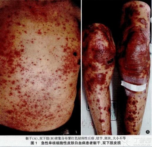 为了提高对本病的认识,减少误诊,附上几例文献上的皮肤白血病皮损