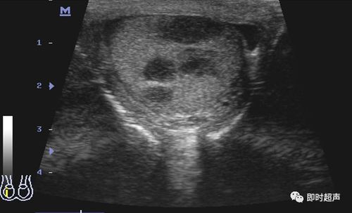 阴囊及其内容物的超声诊断_睾丸