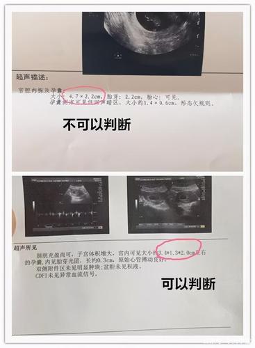 孕囊形状真的可以判断生男生女吗?好多妈妈试过都说准