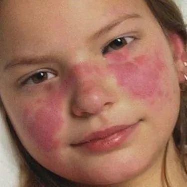 世界狼疮日|儿童系统性红斑狼疮有何特点?又该如何治疗?