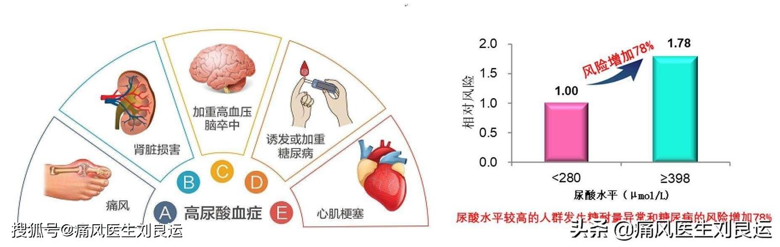青岛人高尿酸血症与痛风居于前列,其实与之相关的其它疾病尤其是"三高