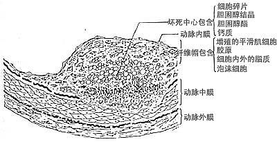 图16-3 动脉粥样硬化纤维斑块切面结构示意显示纤维斑块为单层内皮