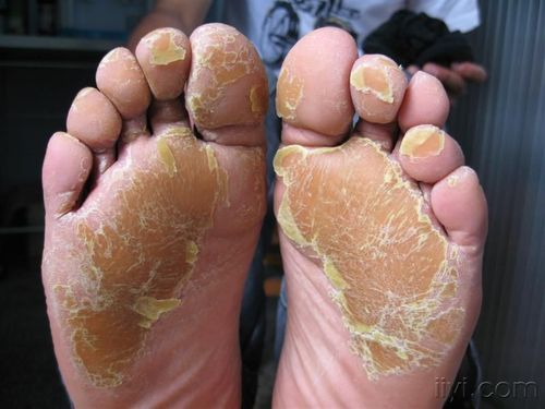 看图说病——角化性湿疹?