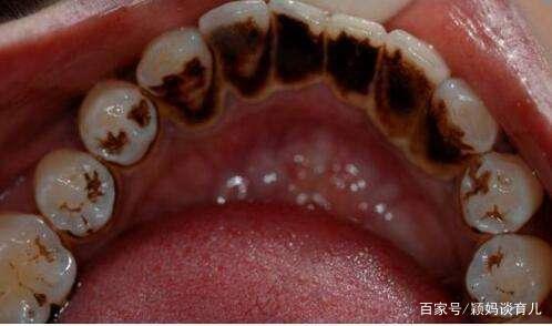 两岁孩子蛀牙太严重医生的话暗示与父母关系很大家长要借鉴