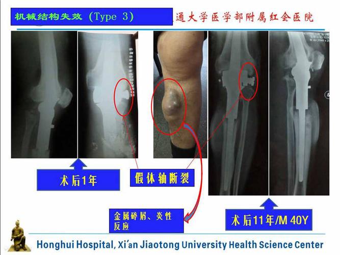 第四十四讲:组配式人工关节重建膝关节周围骨肿瘤切除后骨缺损