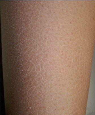 这种鱼鳞状"花纹"是皮肤干燥症(xerosis)的表现,常伴瘙痒,和皮肤功能