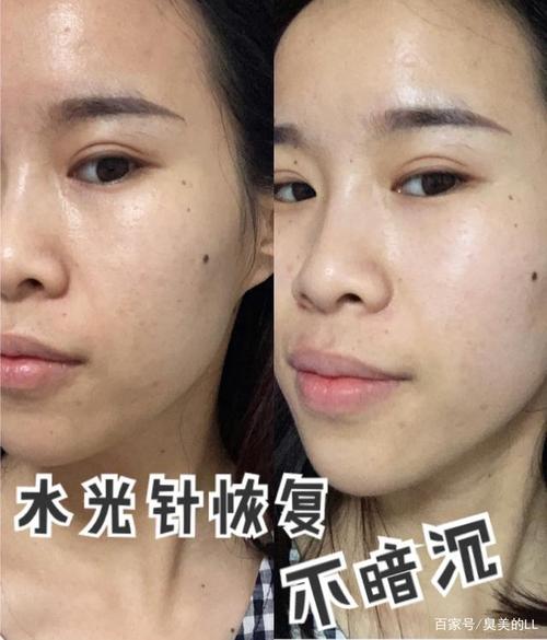 水光针恢复对比图