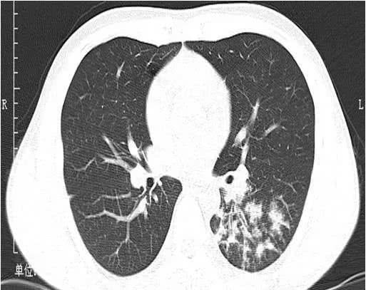病例  :男    岁患者,另一例小叶性肺炎.