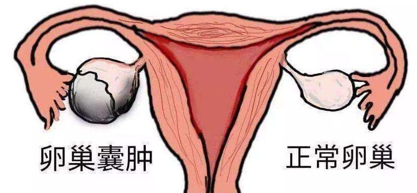 卵巢囊肿会影响怀孕吗?看专家怎么说