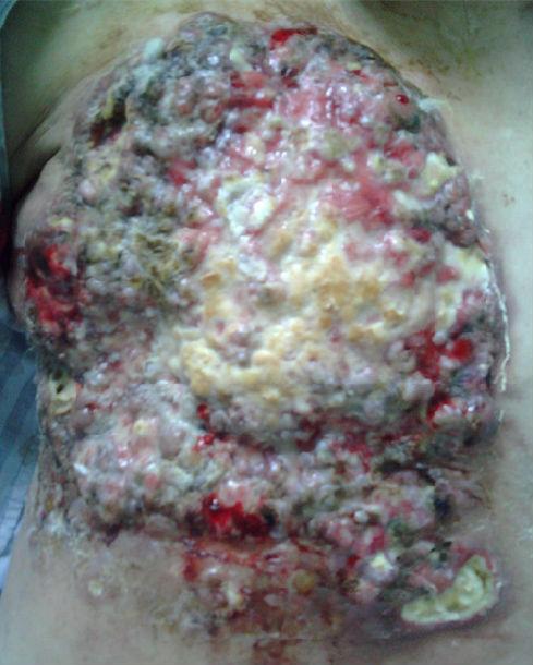 局部晚期乳腺癌病例分享一例图片很震撼胆小者勿看