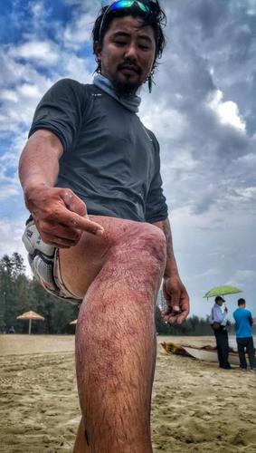 庹俊卿在航行中意外被水母蛰伤的右腿.