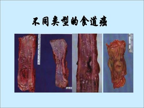 恶性肿瘤的病因ppt