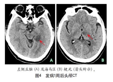 发病1周后头颅ct(2020-05-27)示:左侧丘脑及海马区梗死(图4).