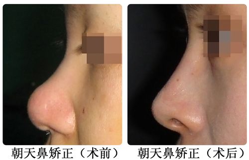 朝天鼻矫正术前术后对比图