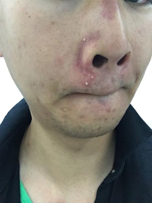 嘴巴人中,鼻翼周边经常长小脓痘痘,如图.想知道为什么