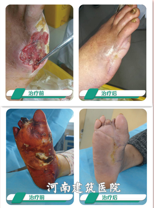 治疗糖尿病伤口溃烂不愈合有什么偏方吗?