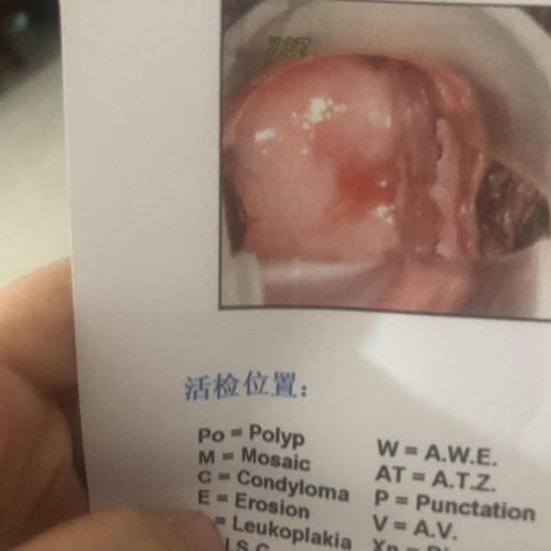 姐妹们我的阴道镜醋酸变白,是病变还是炎症呢?