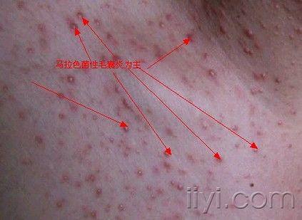 这个是痤疮还是糠秕孢子菌毛囊炎呢?