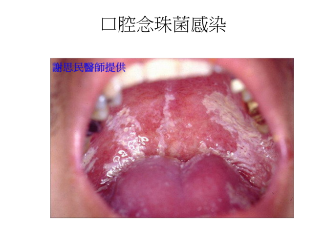 口腔念珠菌感染.ppt