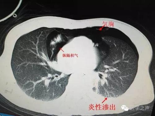 气胸的ct表现及诊断