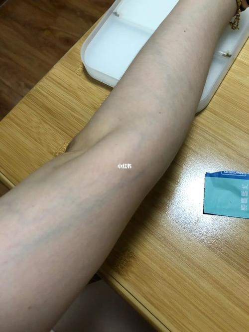 手臂上青筋明显 上肢也会有静脉曲张吗?