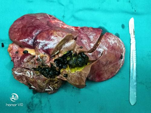 腔镜左半肝(肝内胆管结石,左肝蒂鞘内解剖)