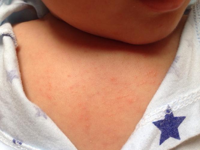问:请问宝宝胸口这是湿疹还是痱子?