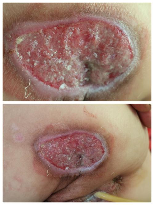 自体微粒皮种植