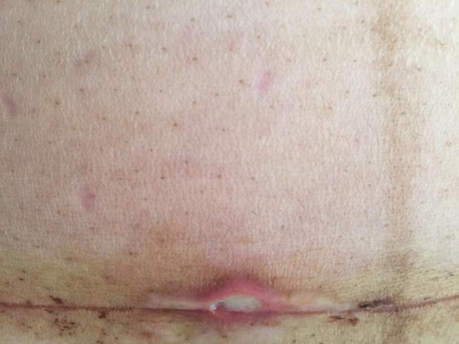 帮忙看看刨腹产刀口怎么了 月子期间不能出门去医院啊