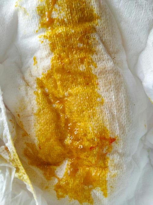 有谁知道宝宝拉的粑粑里带血丝是怎么回事?