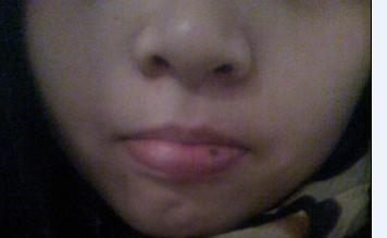 我的下嘴唇唇红那个半年前长了颗痣,开始没太注意,但是现在这个痣颜色