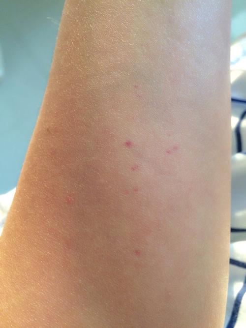 的红点,不疼不痒,就这个地方有,这是怎么回事,什么原因呢,是白血病吗?