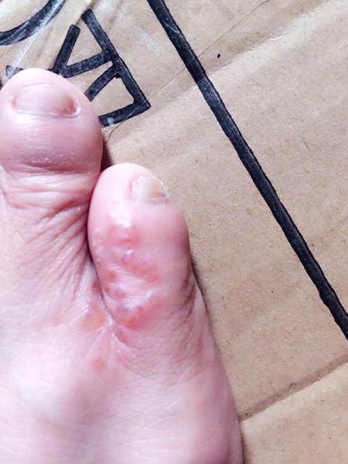 之前一颗一颗比较小个里面透明似的【水泡一样】,现在变得大水泡,有人