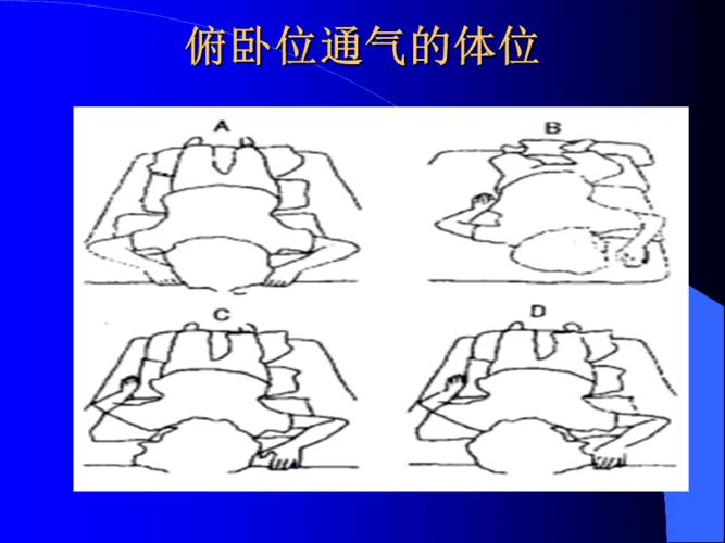 俯卧位通气原理