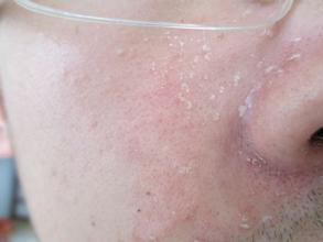 脂溢性皮炎怎么治疗脂溢性皮炎饮食护理