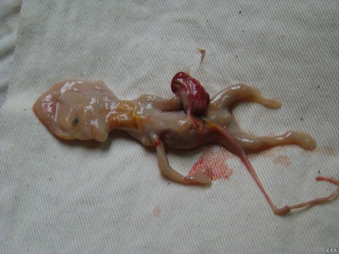 引产出类似干尸样死胎