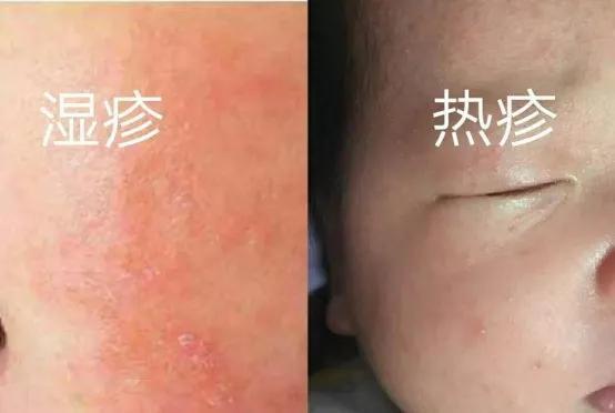 婴儿湿疹热疹超简单实用护理方法嘉堡医护团队为您详细介绍