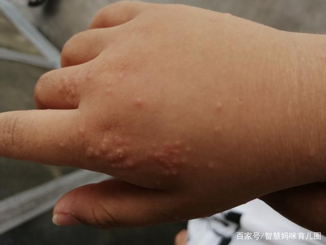 宝宝手上米粒样的小疙瘩,原来是玩惹的祸!