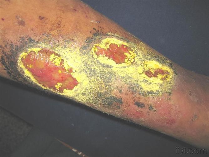 看图识病---------坏疽性脓皮病