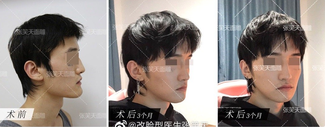 下颌角肥大男生怎么瘦脸