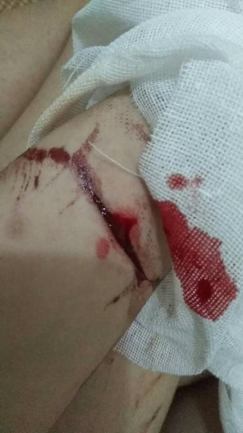 昨晚想看愈合没就拆了结果纱布沾在伤口我慢慢扯下来有点出血我又包上