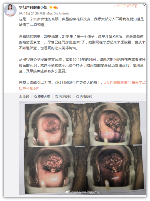 在微博上分享了一个33岁女性的宫颈,典型的宫颈癌菜花样改变
