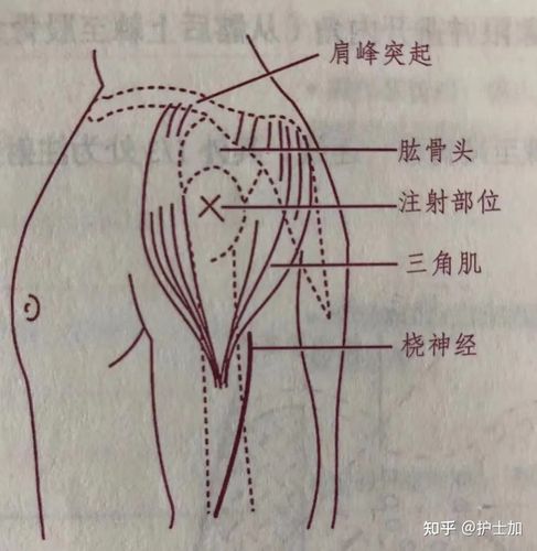 的要求, 新冠病毒疫苗接种途径和接种部位推荐上臂三角肌肌内注射