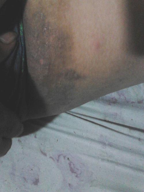 大腿内侧黑黑的,为什么会这样?