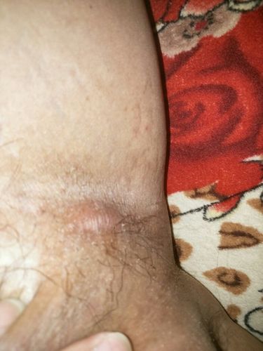 我的腿根部和睾丸之间有块发硬不知道是什么病,按一下有点疼